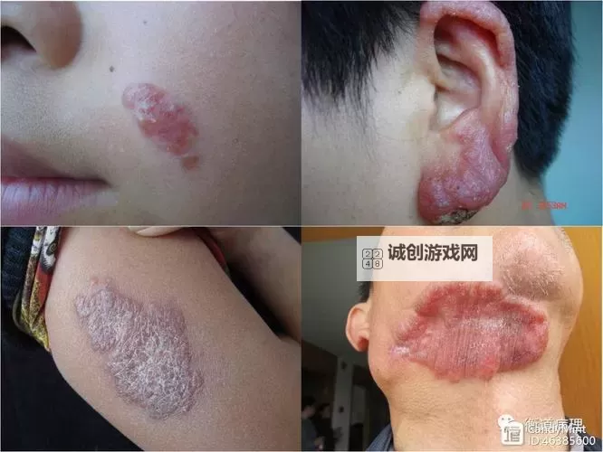 探索writeas两根性器异物肿的成因与处理方法图2