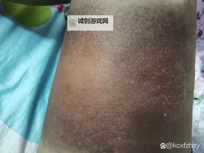 紫黑蘑菇横冲直撞引发红肿JH奇迹偶遇图1